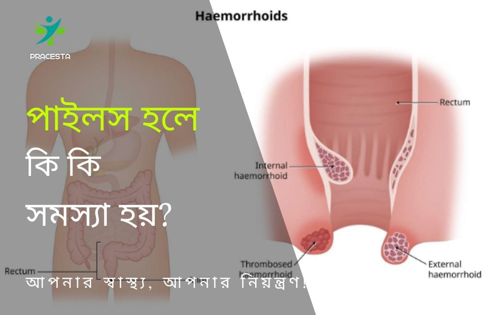 পাইলস হলে কি কি সমস্যা হয়